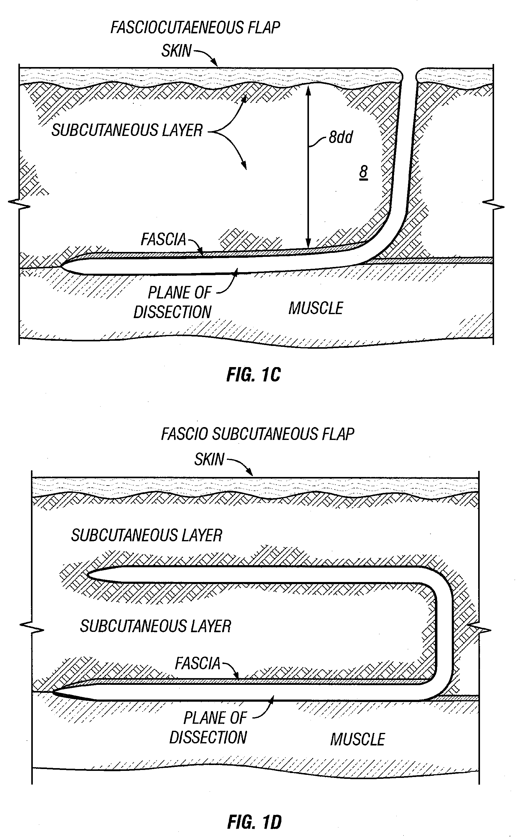 Method and apparatus for surgical dissection