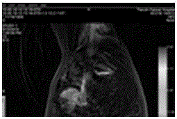 Method for quantitatively determining blood supply level and embolism proportion of tumors