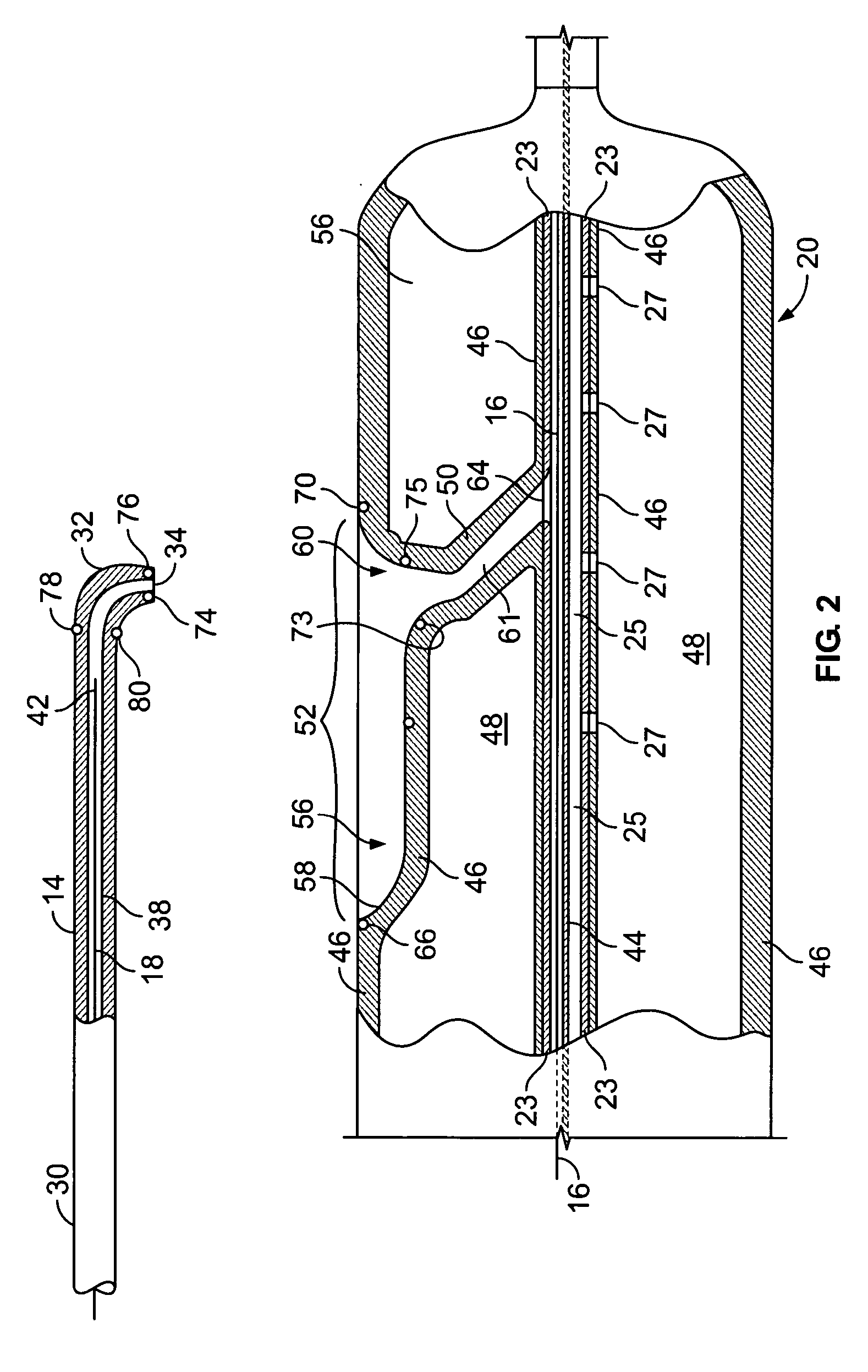 System for treating chronic total occlusion caused by lower extremity arterial disease