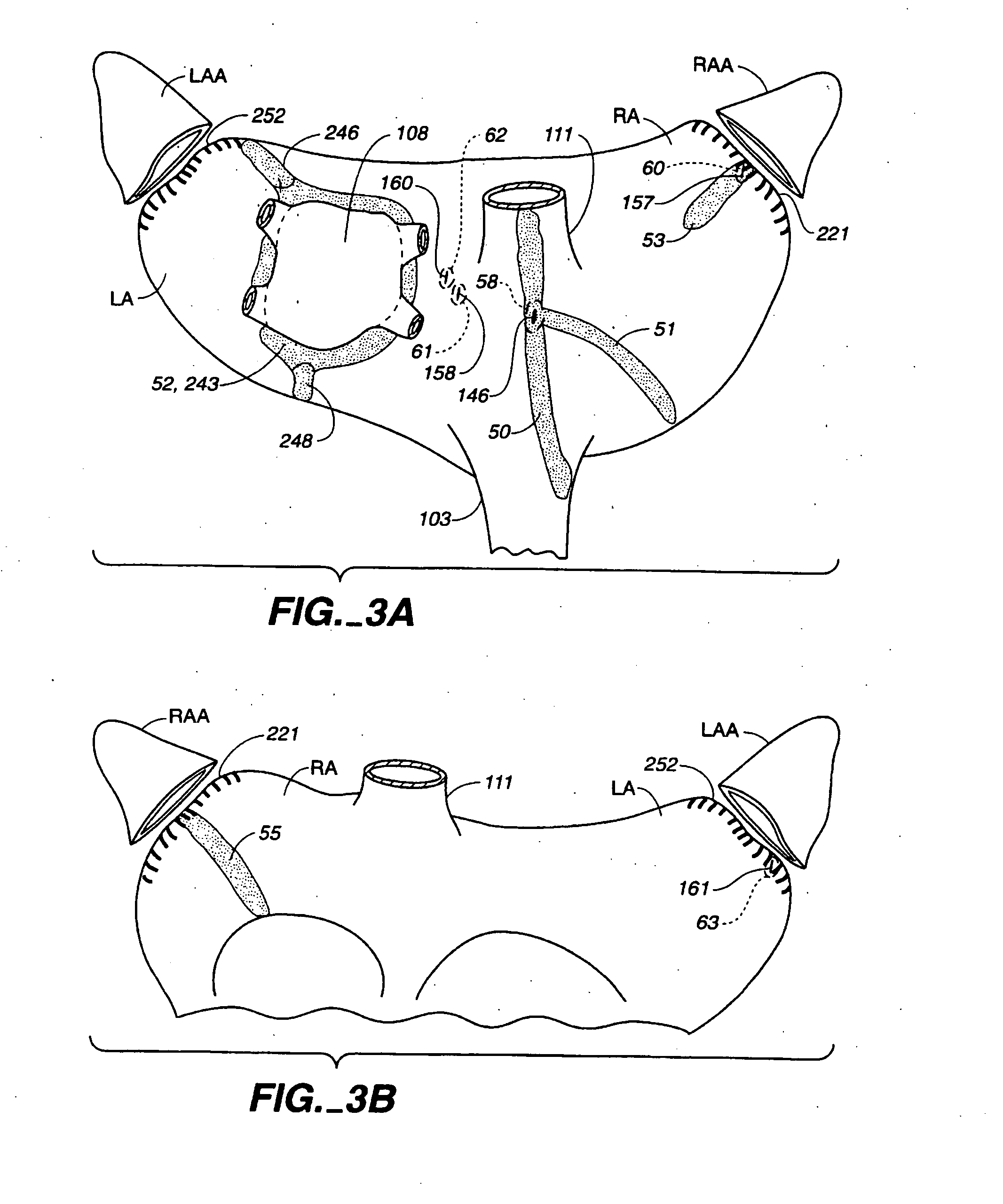 System and methods for treating atrial fibrillation using electroporation