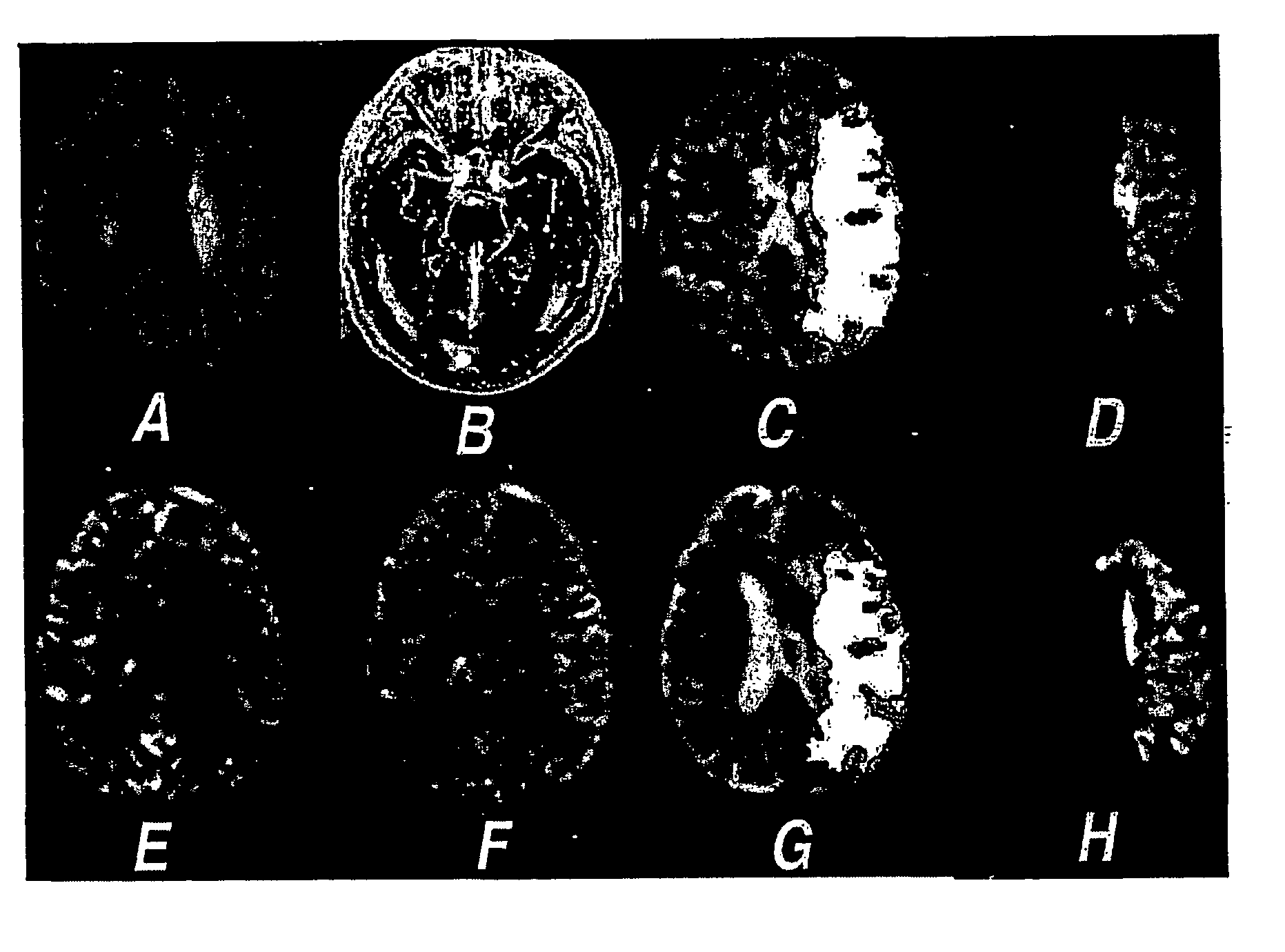 Method of predicting stroke evolution utilising mri