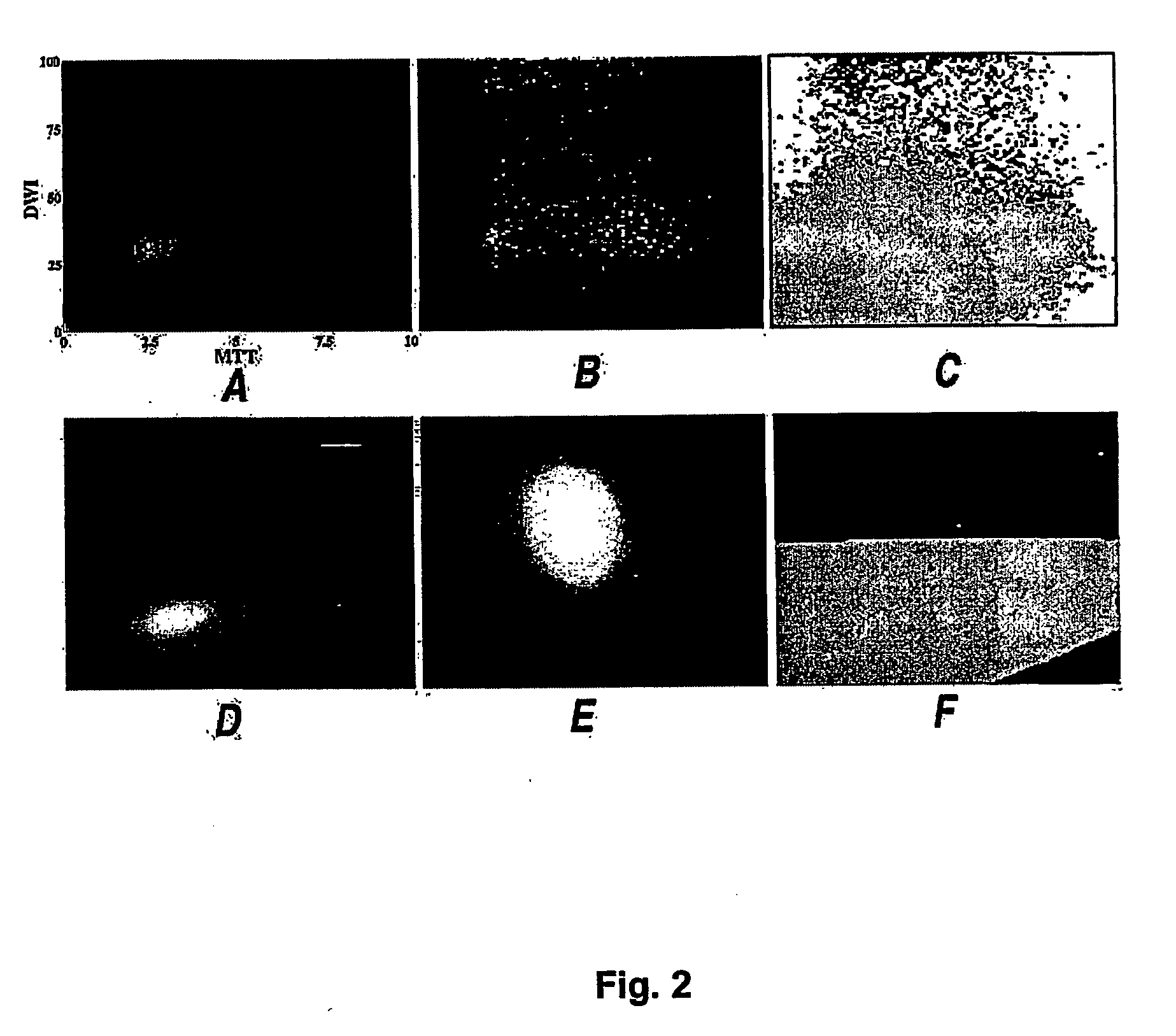 Method of predicting stroke evolution utilising mri