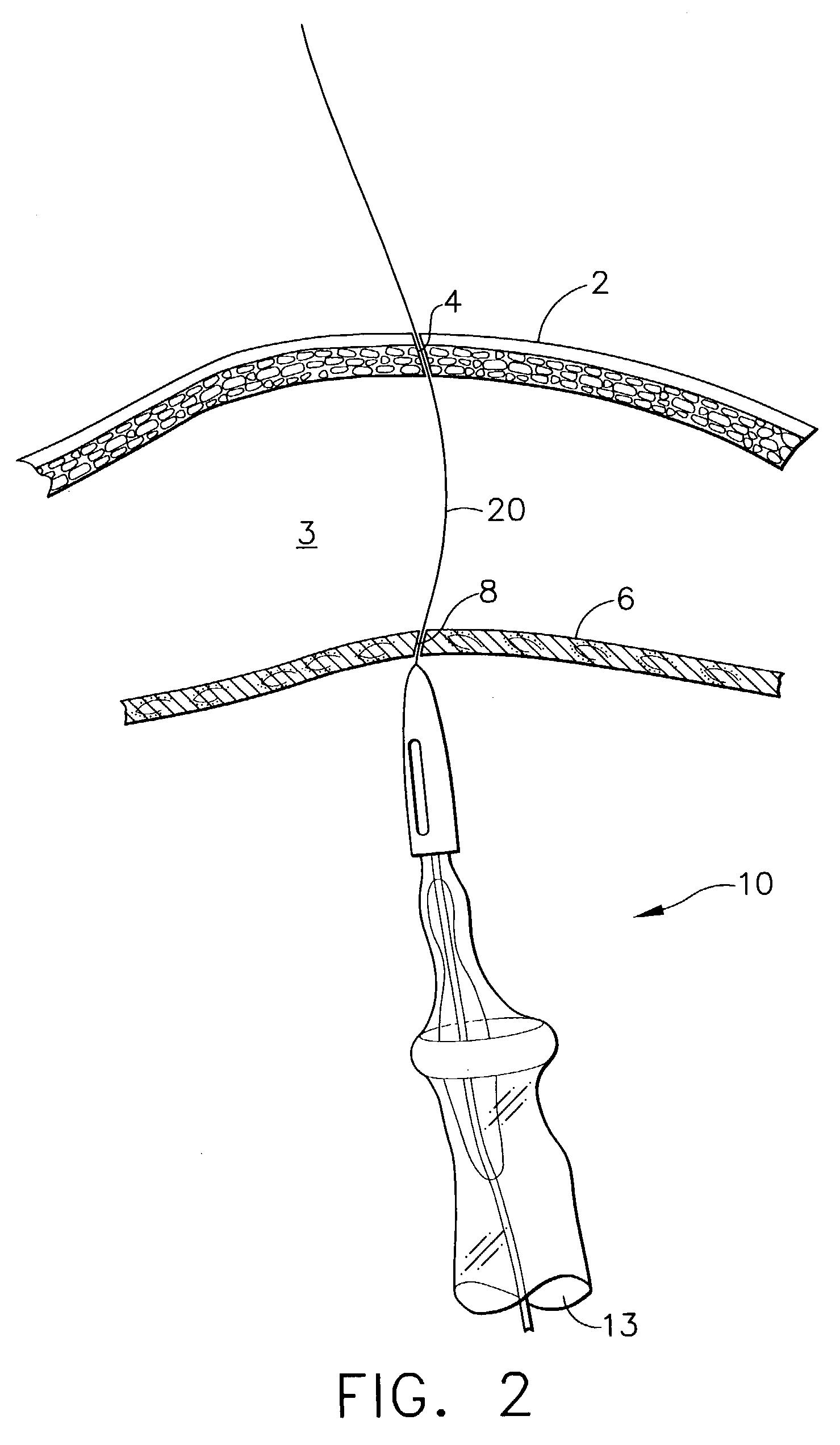 Method for endoscopic, transgastric access into the abdominal cavity