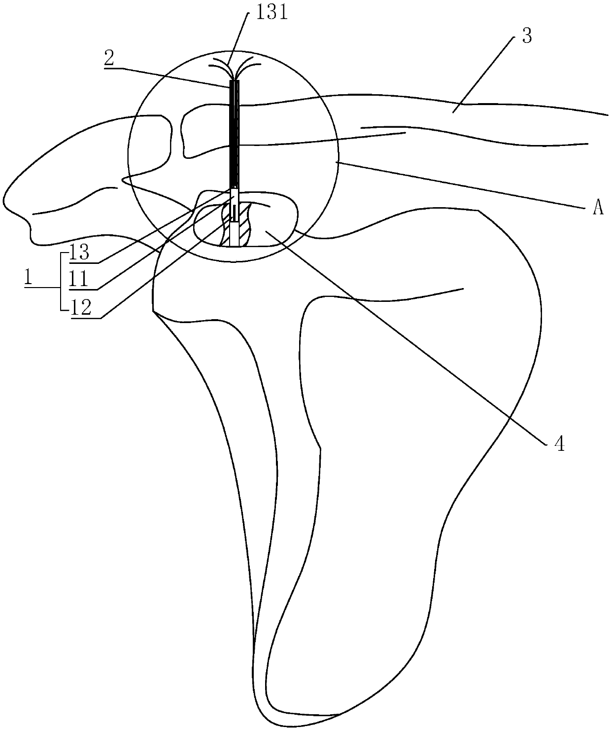 Titanium-nickel memory alloy hook toothed nail for treating acromioclavicular joint dislocation and use method thereof