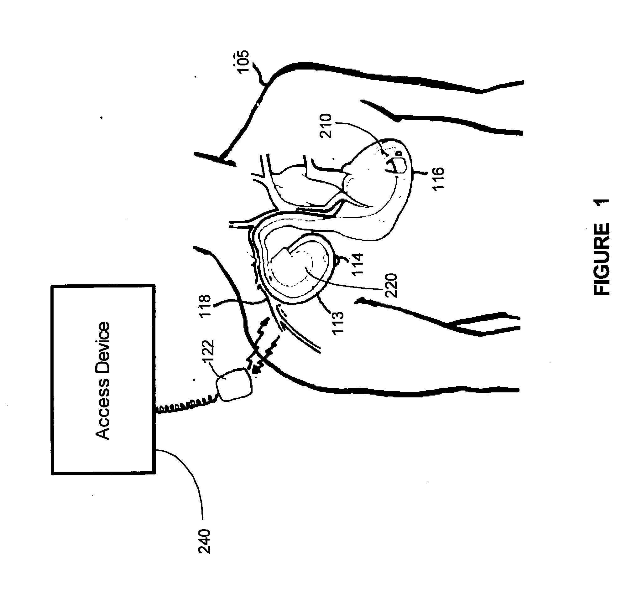 Method and apparatus to detect and monitor the frequency of obstructive sleep apnea