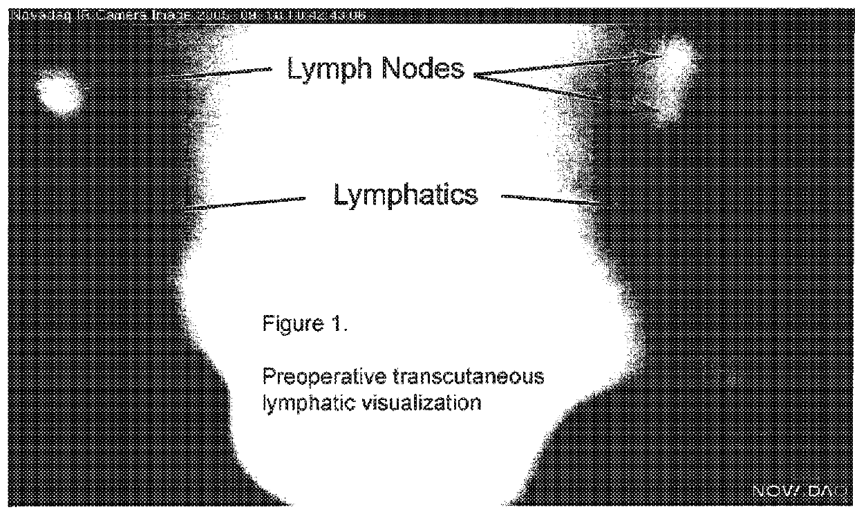 Pre-and-intra-operative localization of penile sentinel nodes