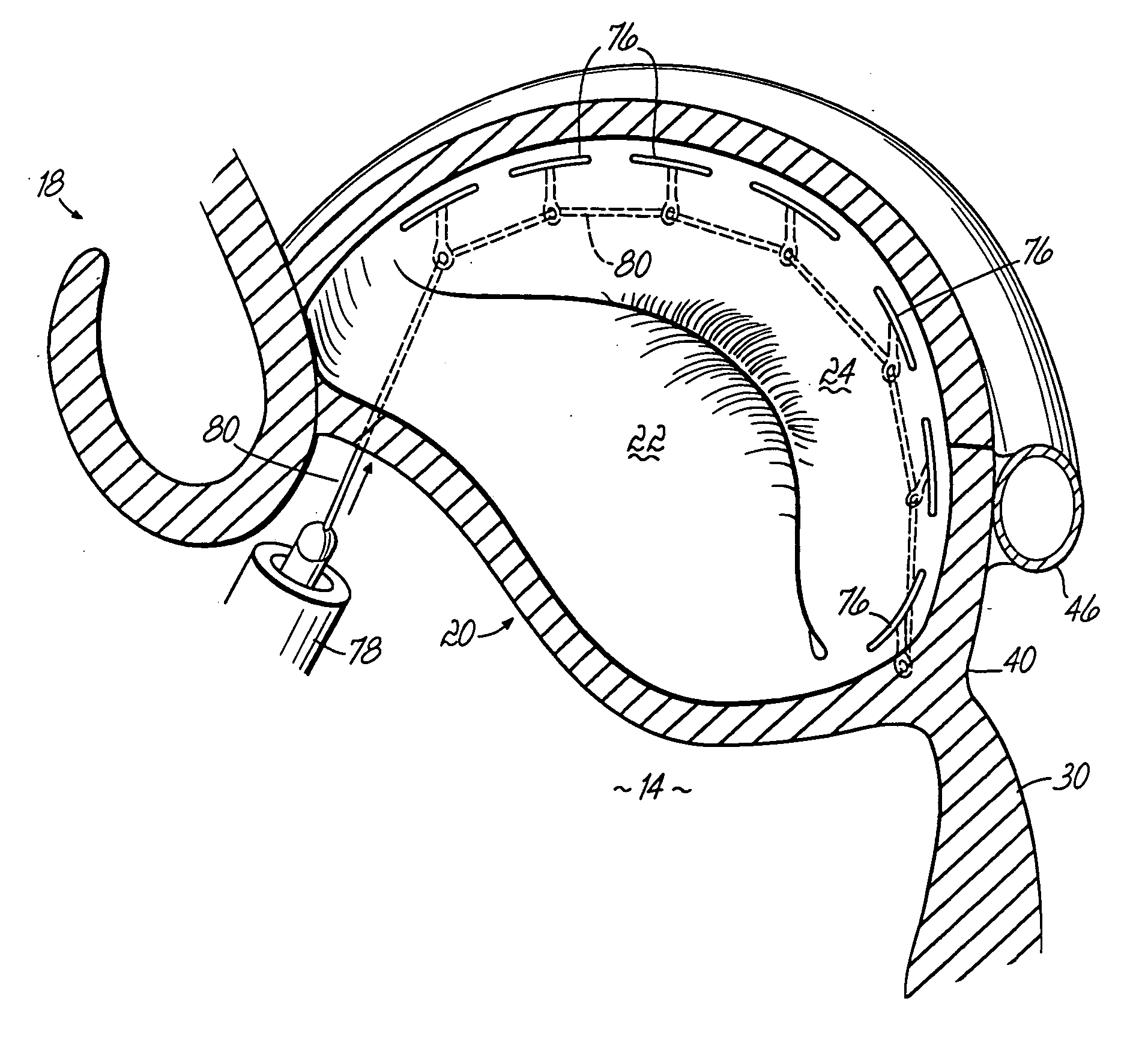 Tissue fastening systems and methods utilizing magnetic guidance