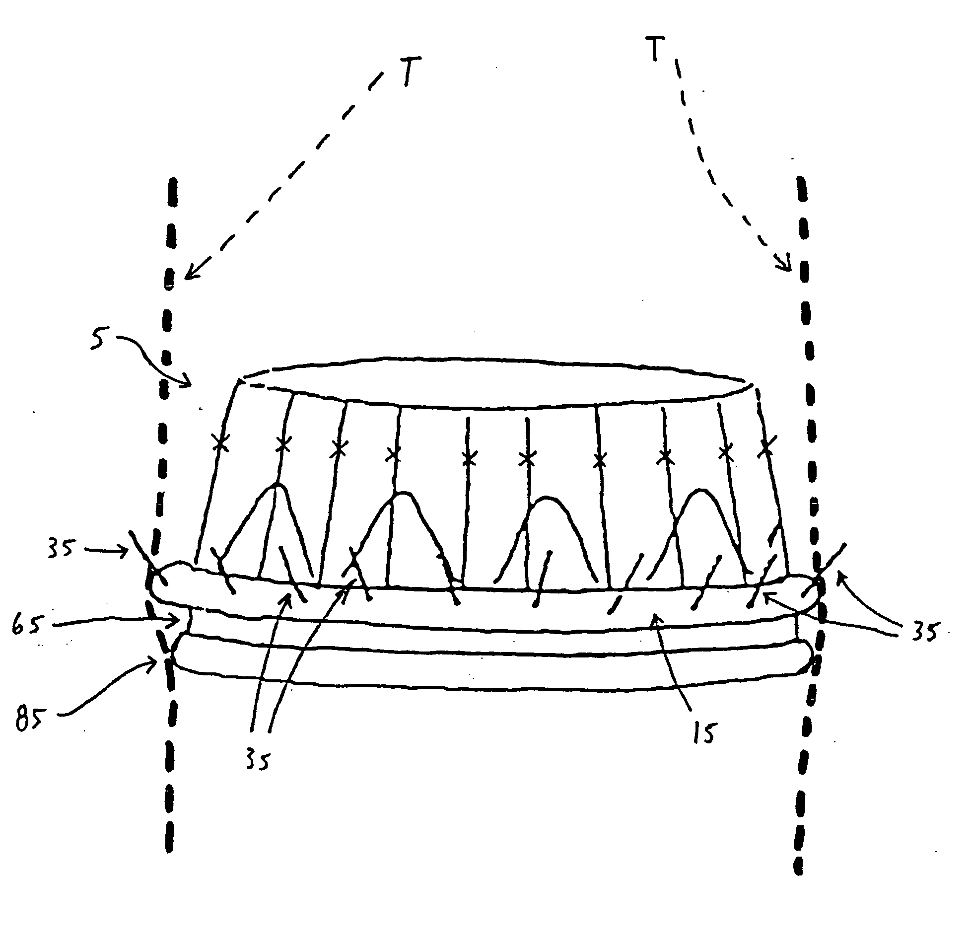 Fixation band for affixing a prosthetic heart valve to tissue