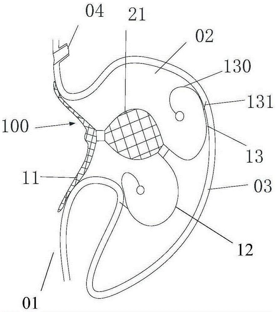 Left atrial appendage closure device