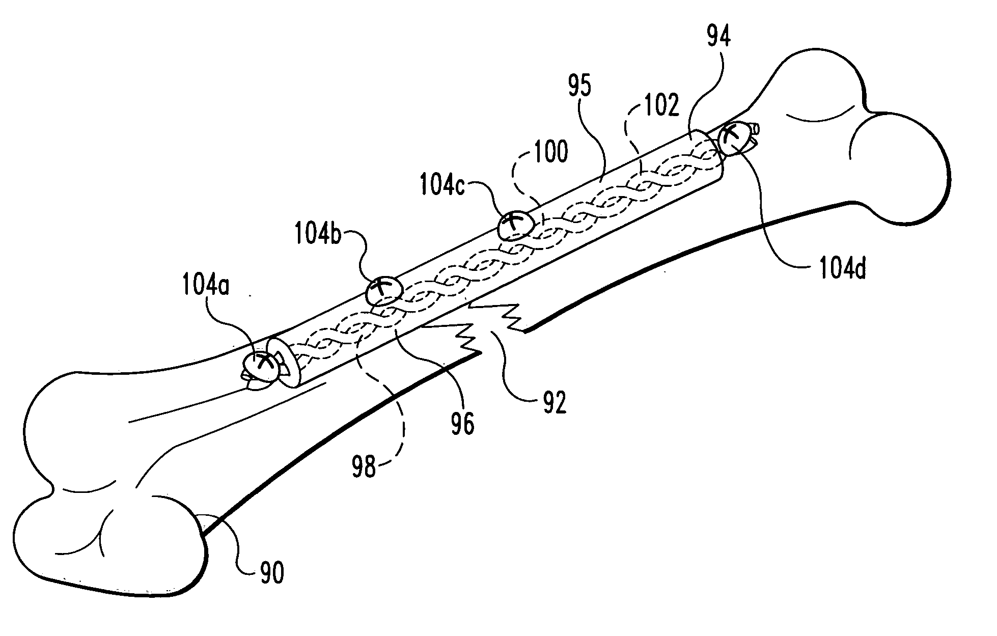 Designed composite degradation for spinal implants