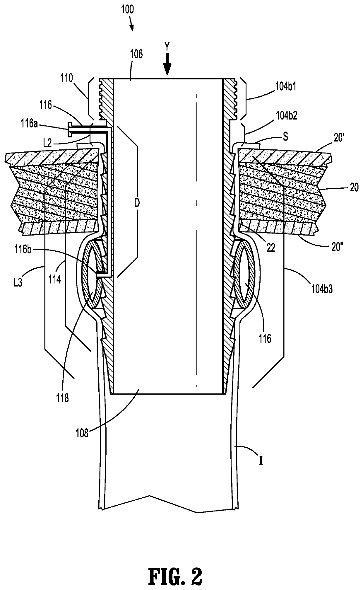 Connection devices for ostomy procedures