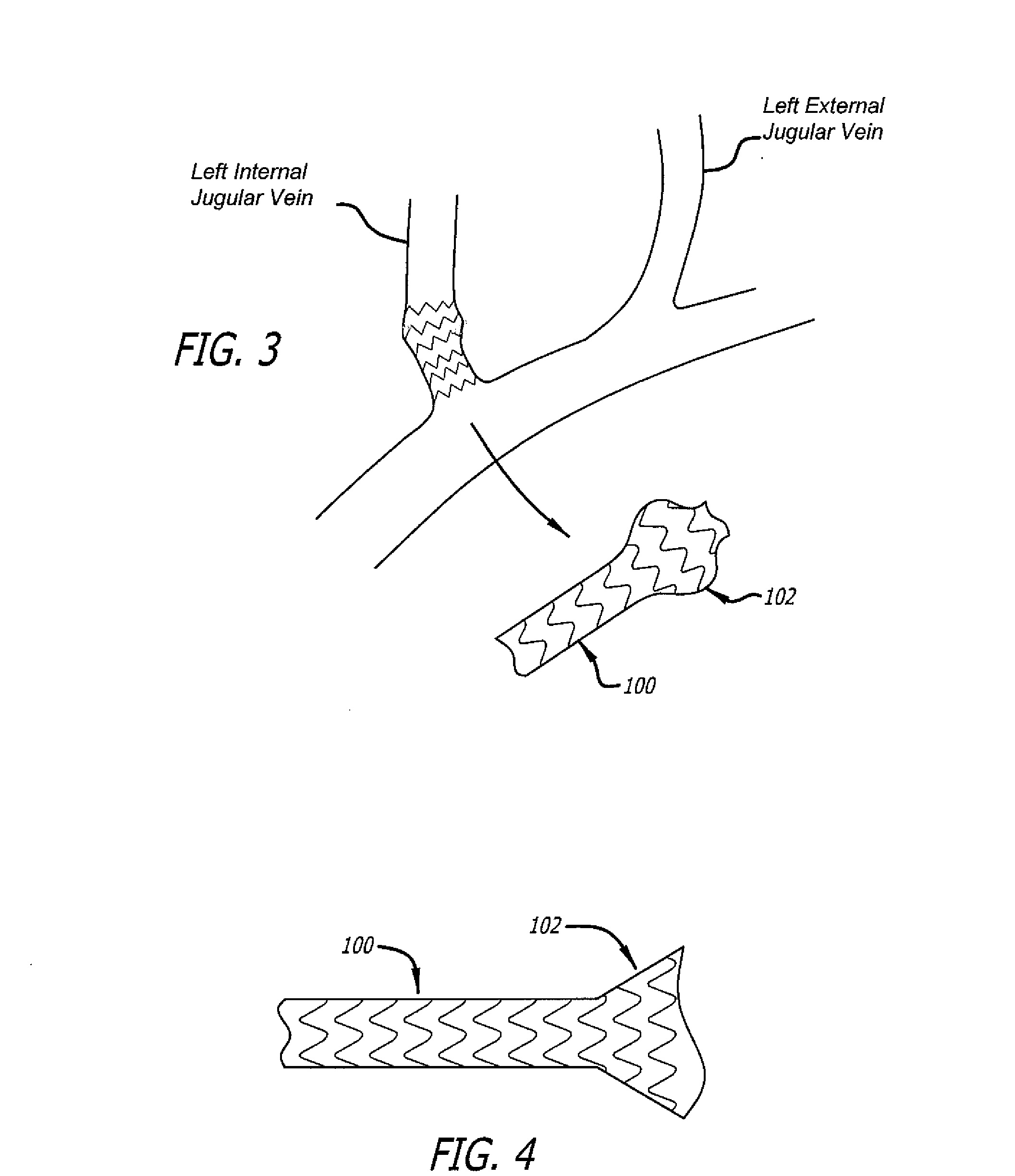 Methods of treating a condition of a vessel in a patient