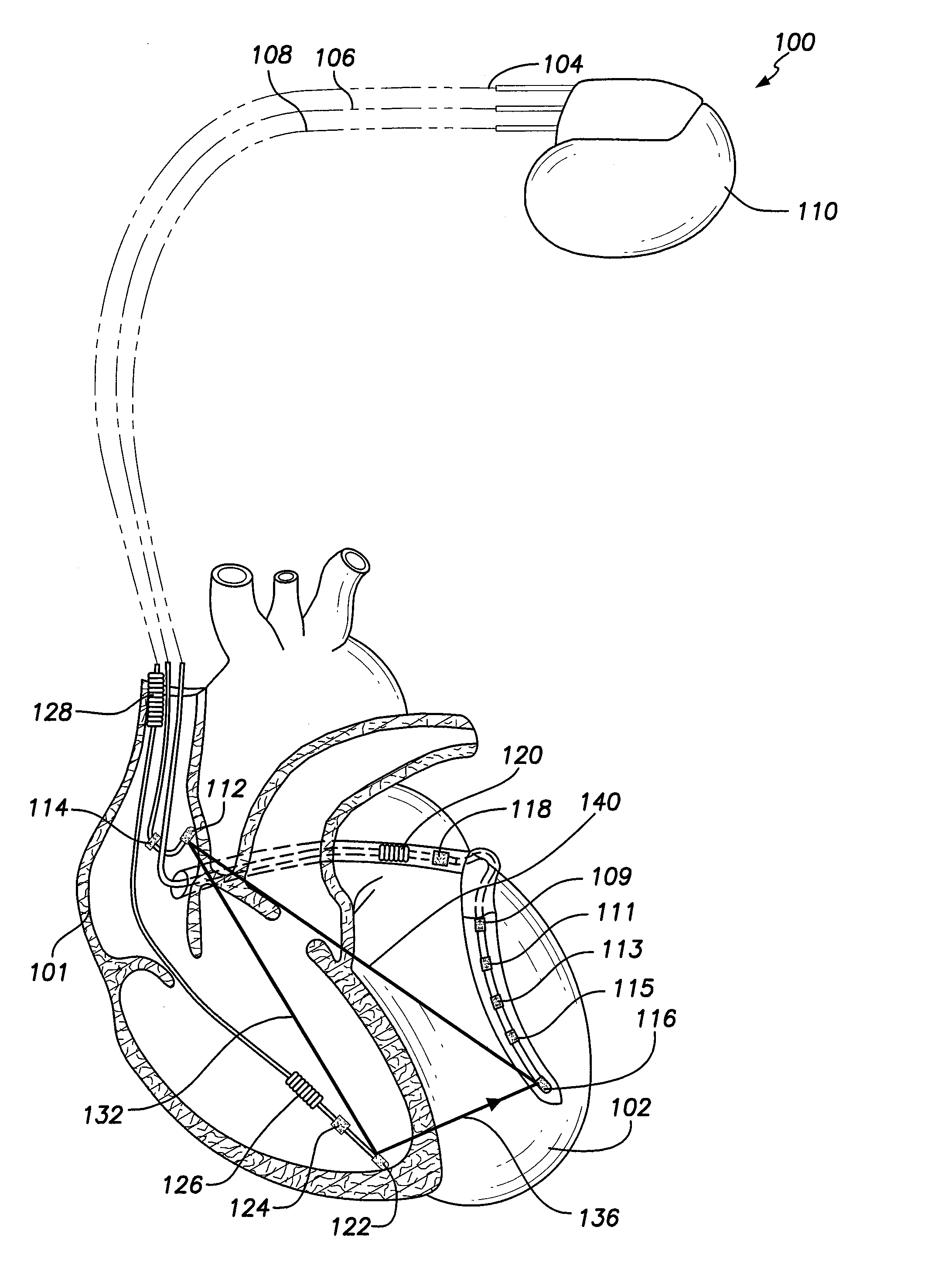 Methods and systems for determining pacing parameters based on repolarization index