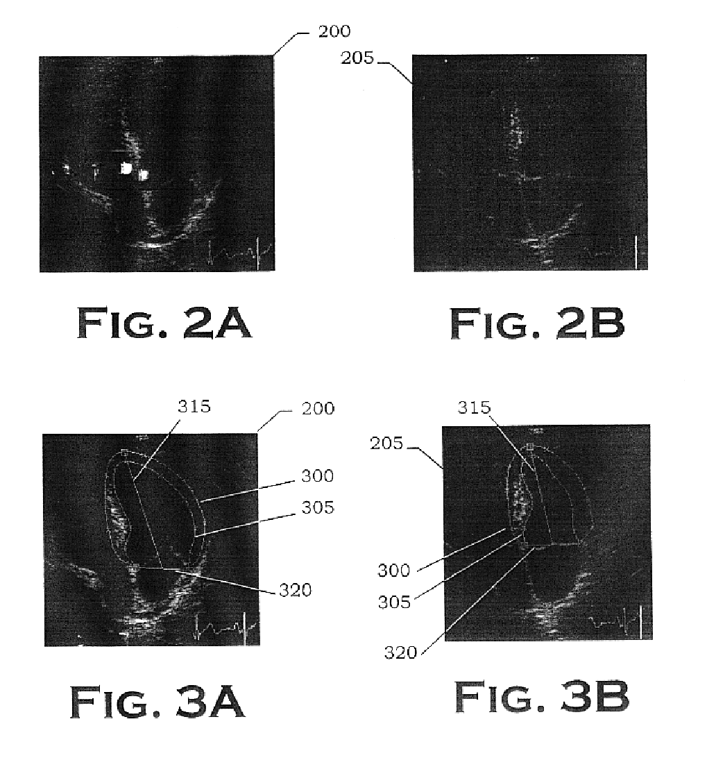 Autonomous boundary detection system for echocardiographic images