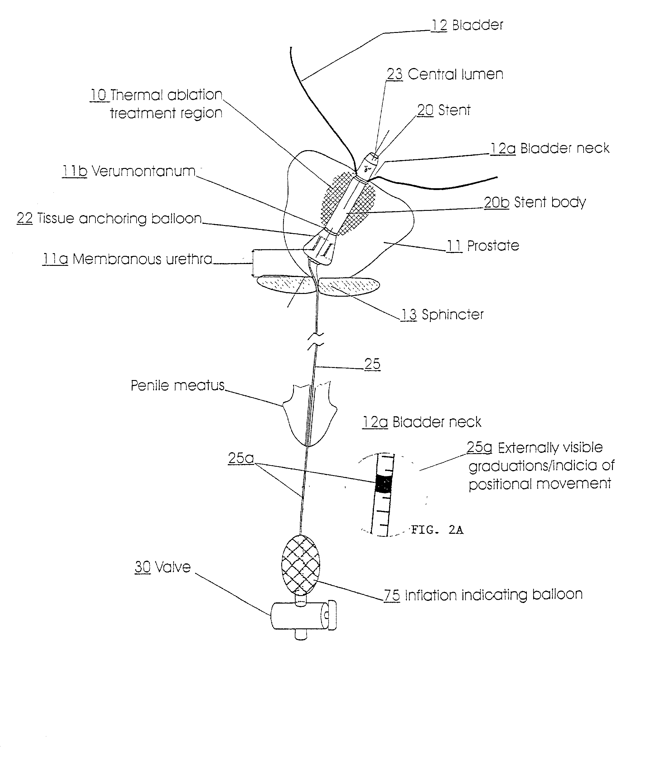 Prostatic stent with localized tissue engaging anchoring means and methods for inhibiting obstruction of the prostatic urethra