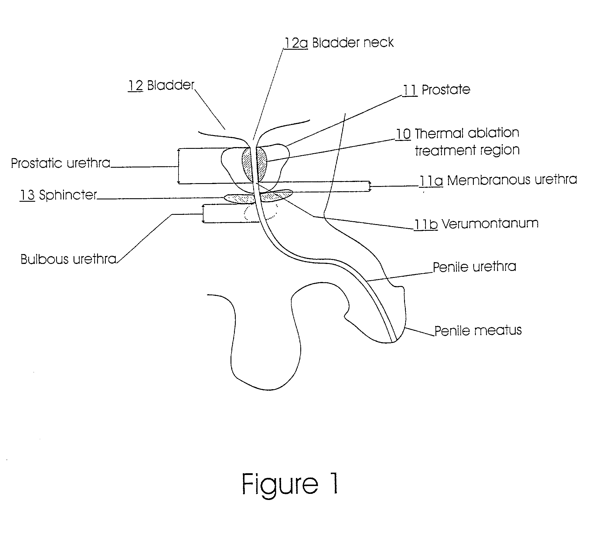 Prostatic stent with localized tissue engaging anchoring means and methods for inhibiting obstruction of the prostatic urethra