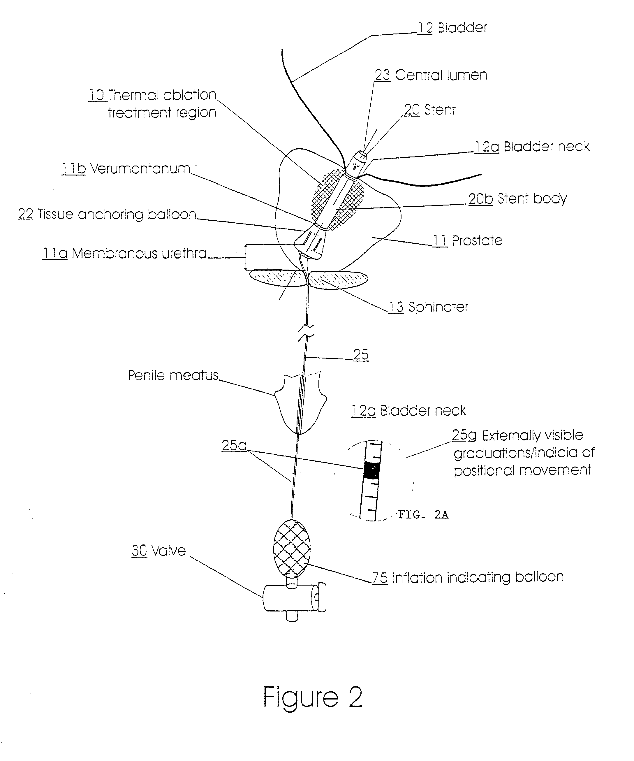 Prostatic stent with localized tissue engaging anchoring means and methods for inhibiting obstruction of the prostatic urethra