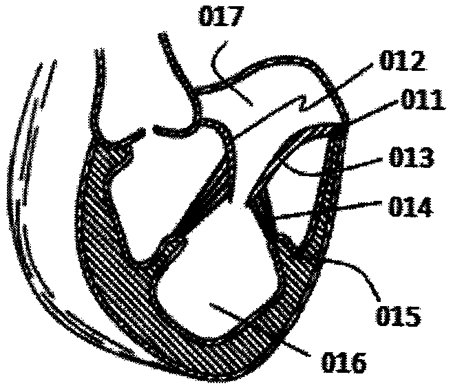 Substep clamping-type valve prosthesis and conveying system thereof