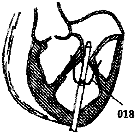 Substep clamping-type valve prosthesis and conveying system thereof