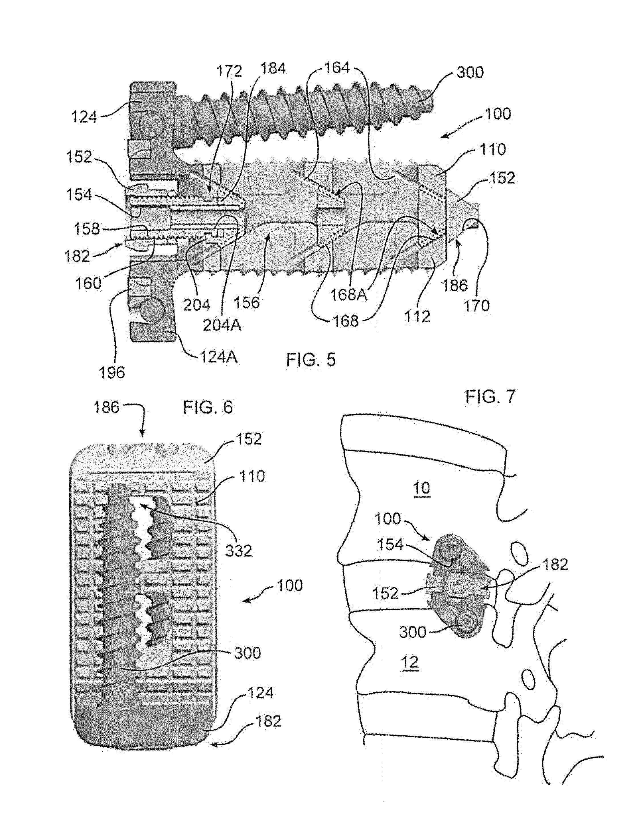 Expandable Vertebral Implant