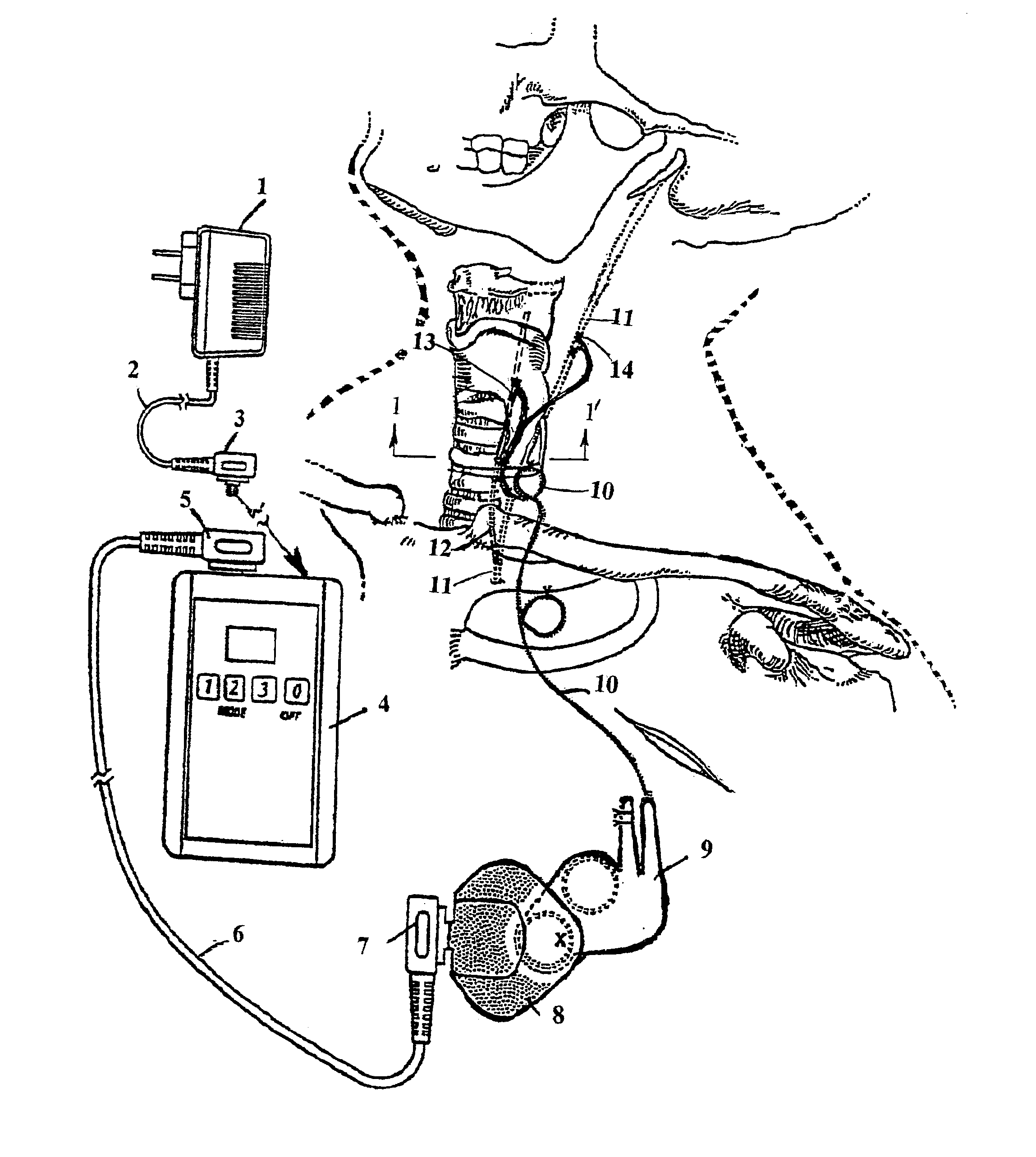 Method and system for dynamic vocal fold closure with neuro-electrical stimulation