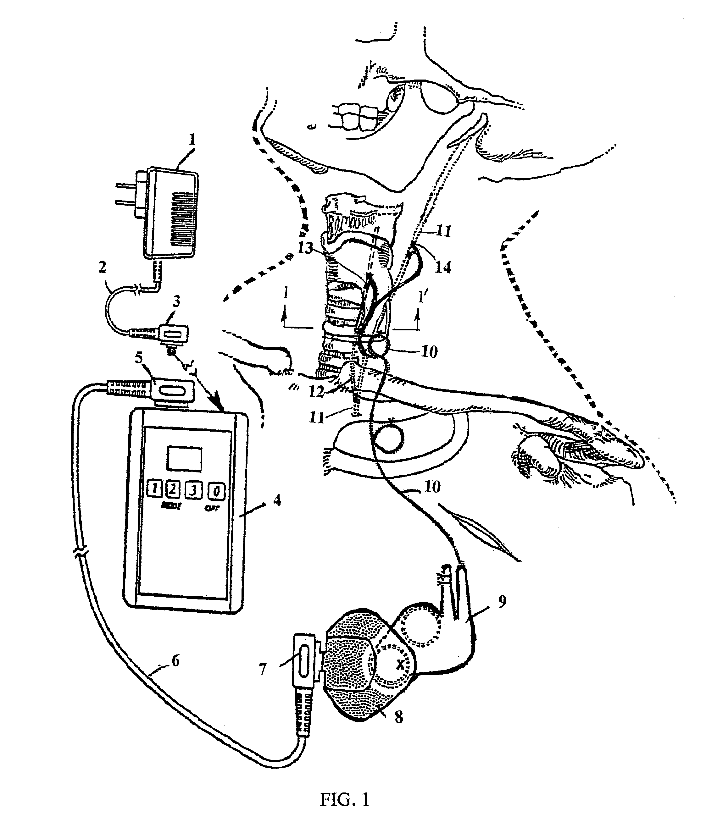 Method and system for dynamic vocal fold closure with neuro-electrical stimulation