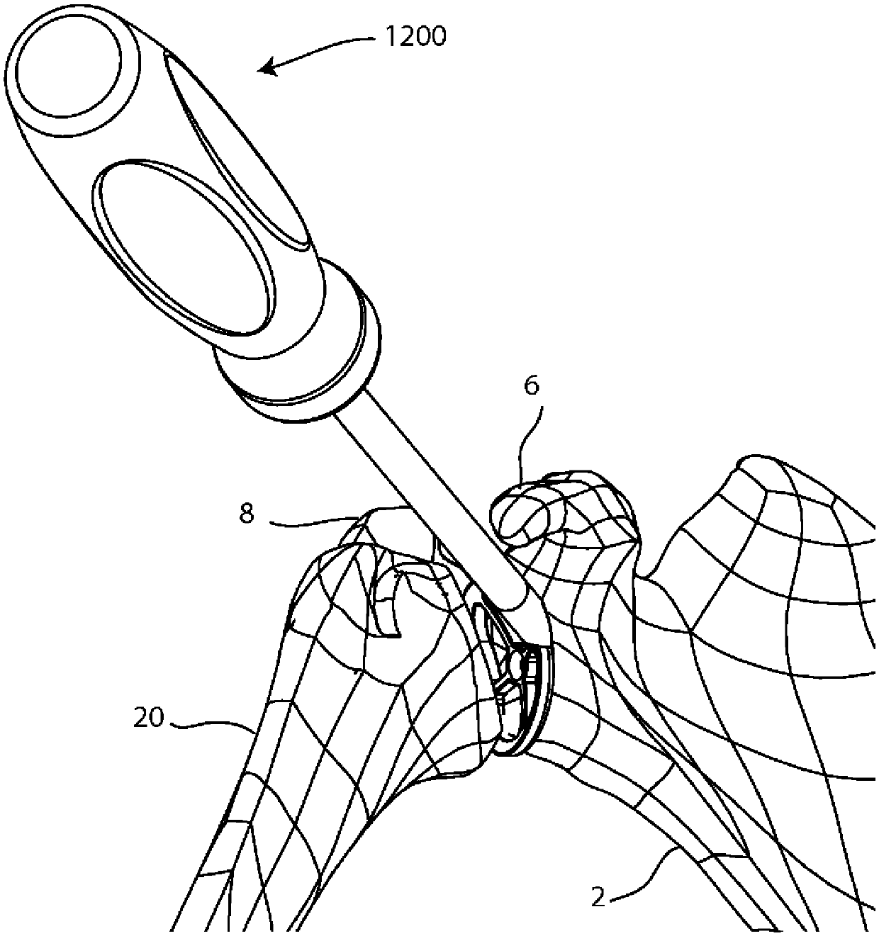 Glenoid arthroplasty