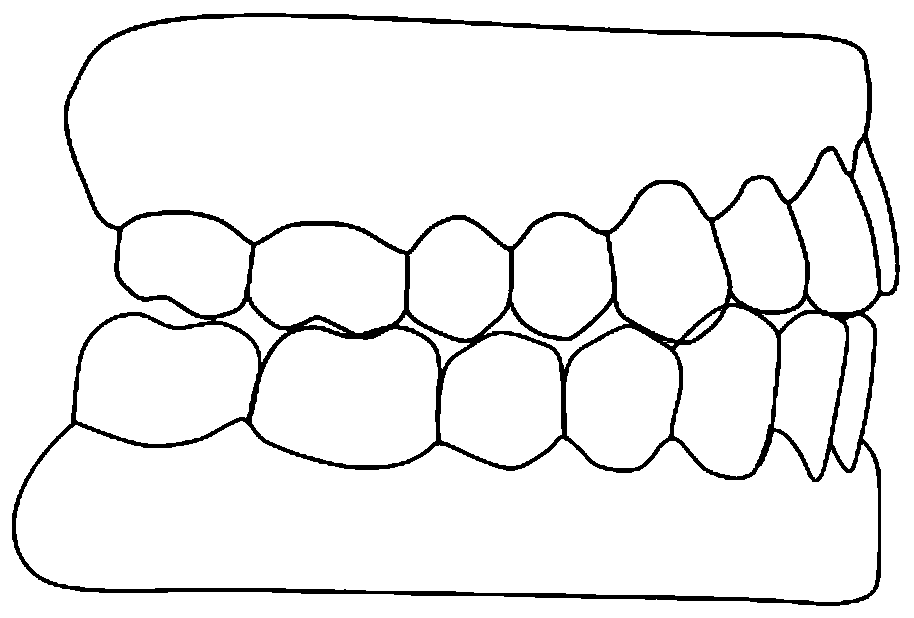 Preparation method of appliance for abnormality repositioning of mandible