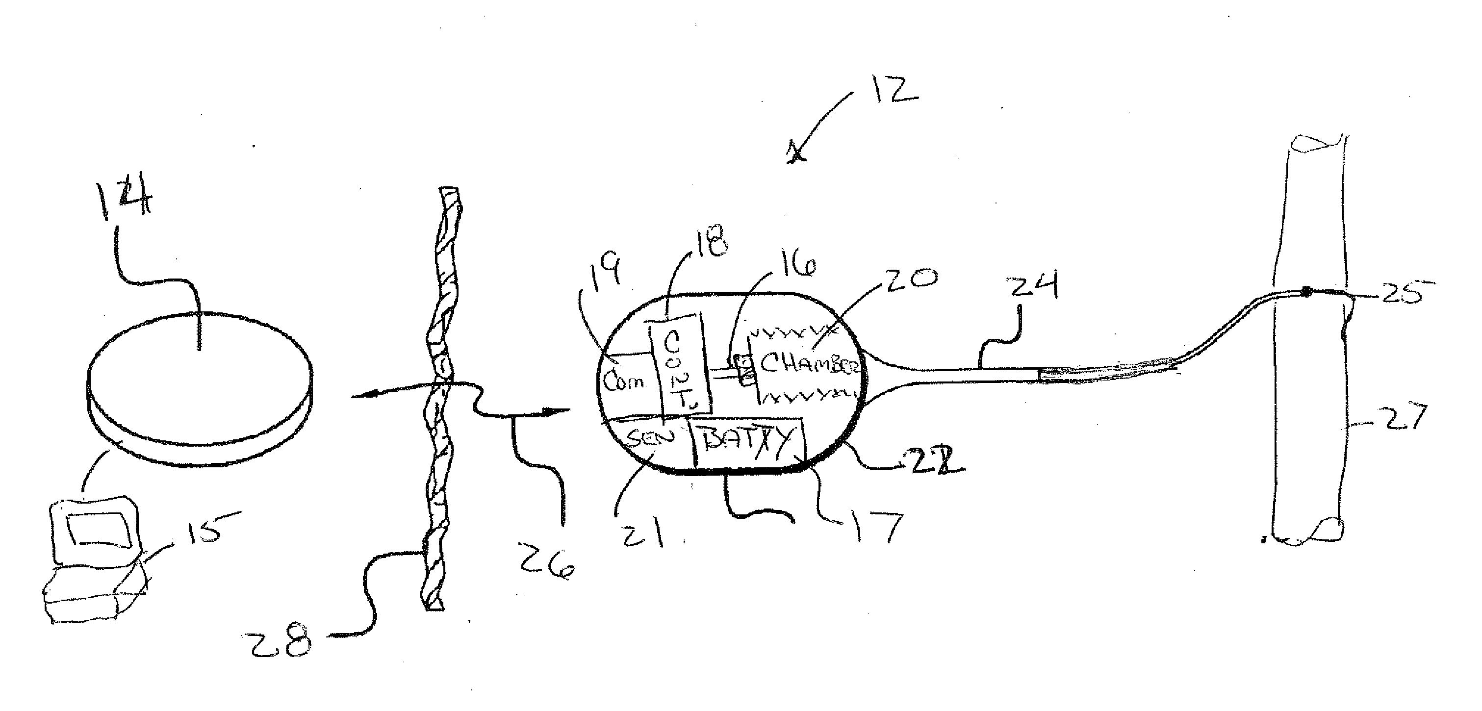 Implantable drug delivery system having periodic drug delivery regimen to avoid granulomas