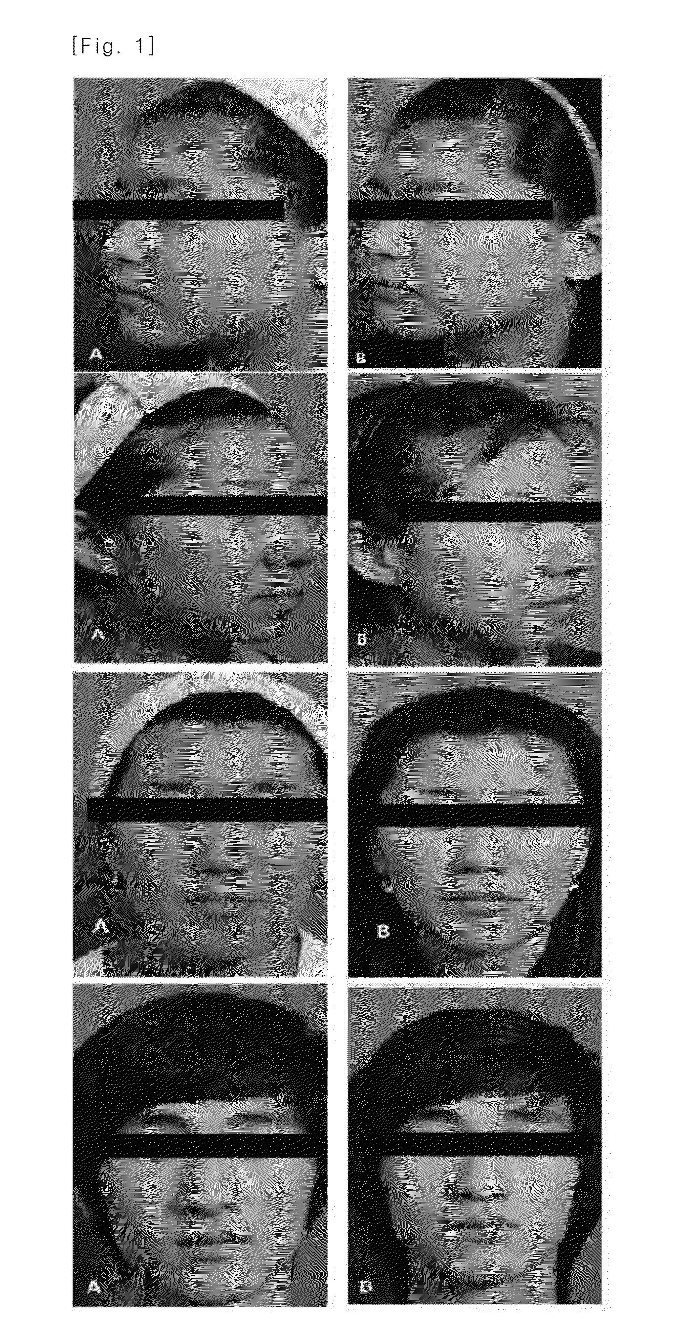 Pharmaceutical composition for treating scars on the skin, and method for treating scars on the skin using same