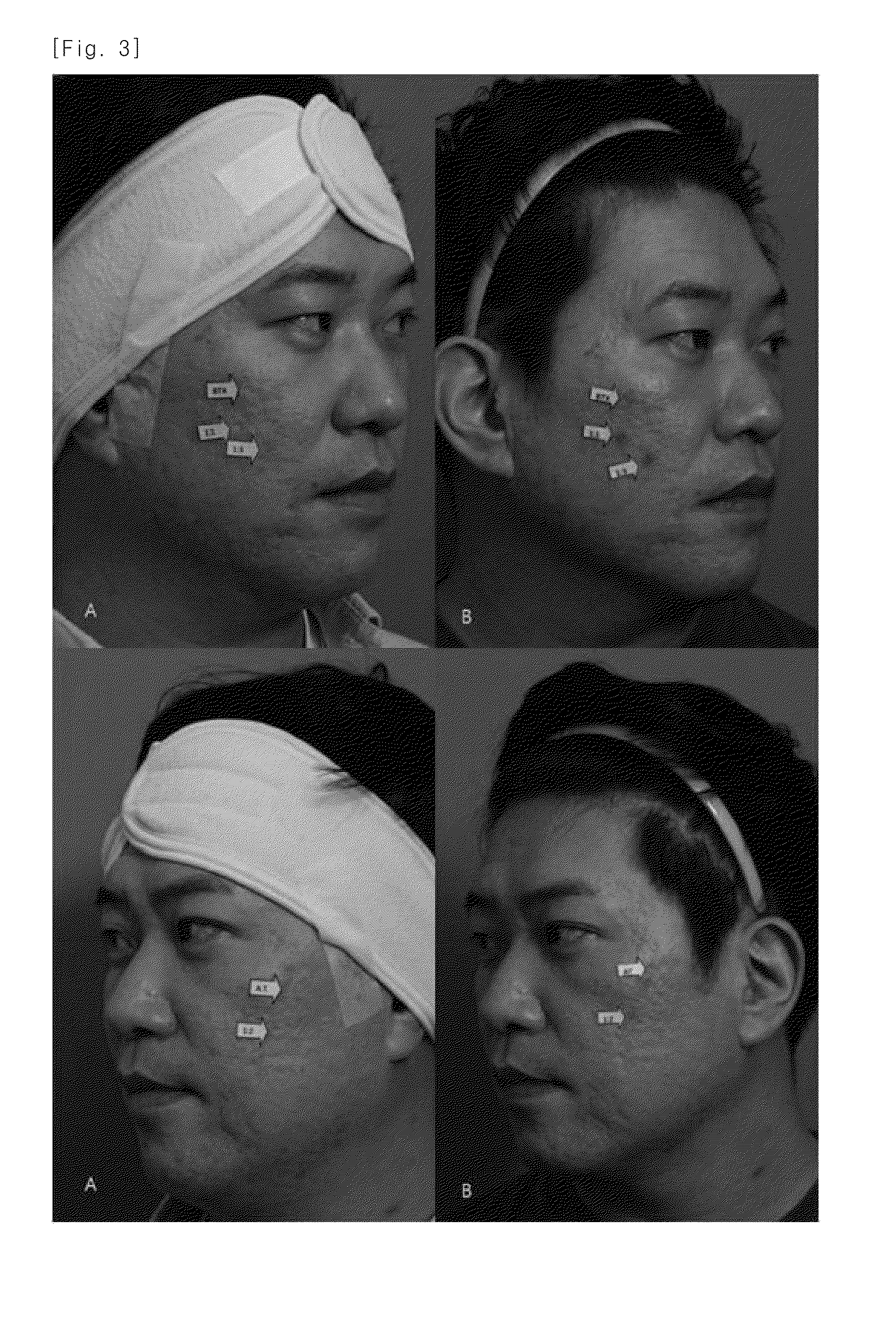 Pharmaceutical composition for treating scars on the skin, and method for treating scars on the skin using same