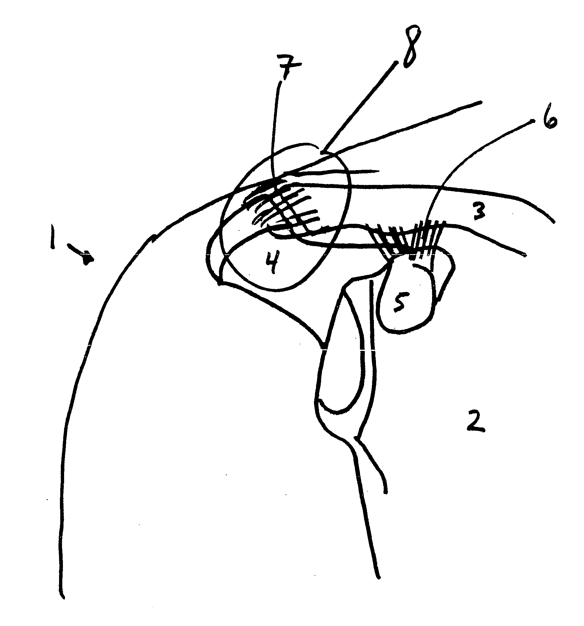 Acromioclavicular joint repair system