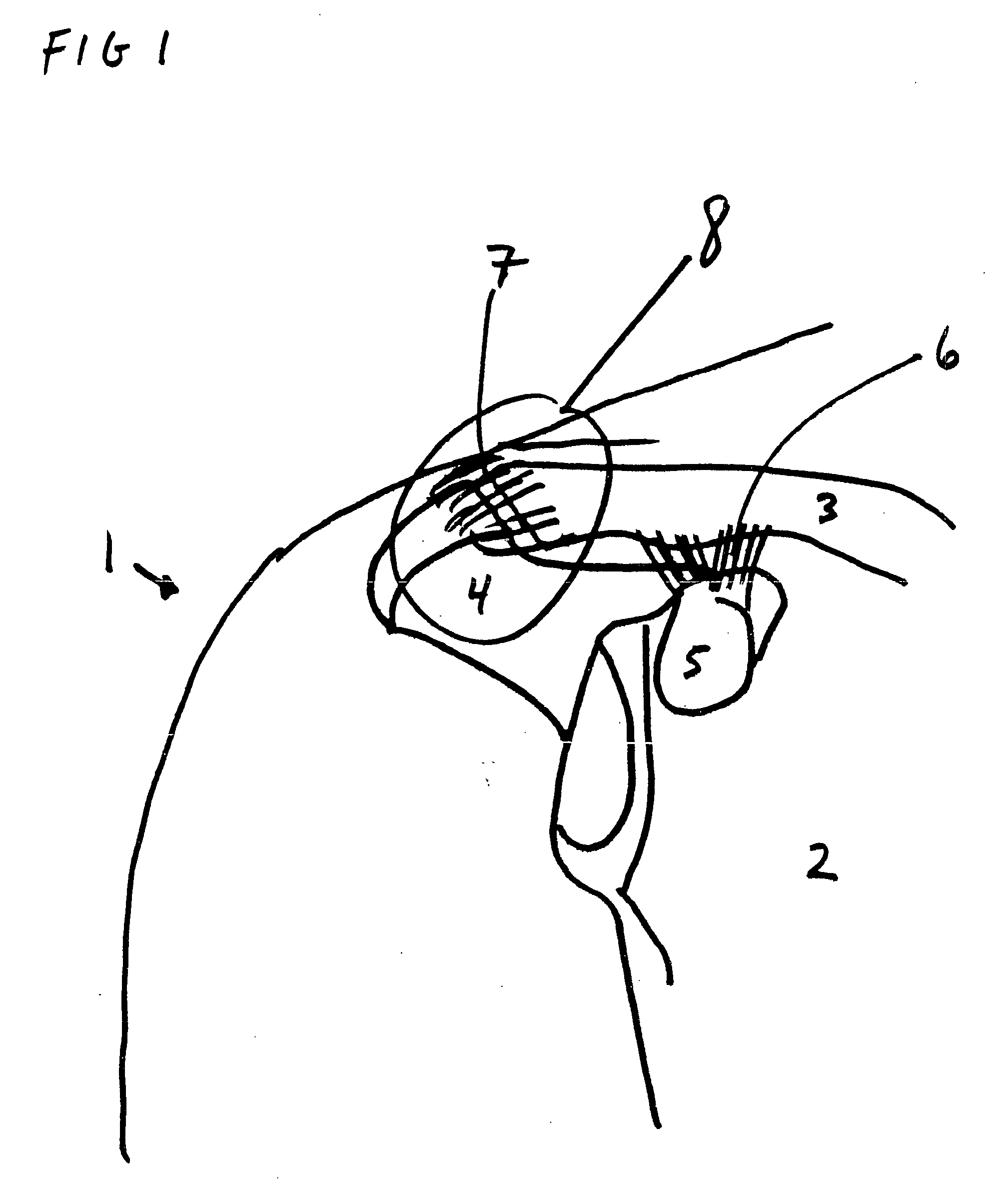 Acromioclavicular joint repair system