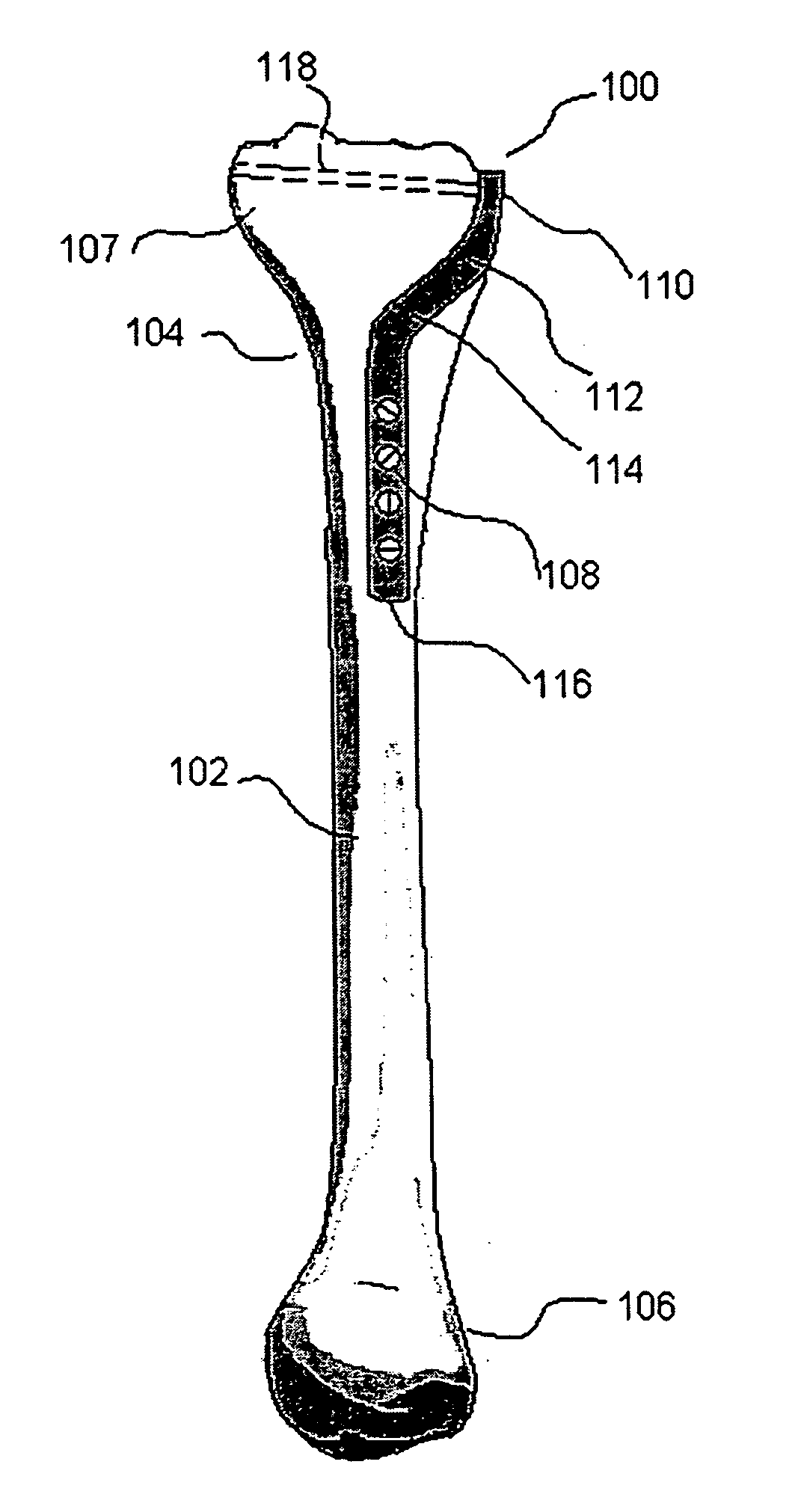 Distal humeral plate