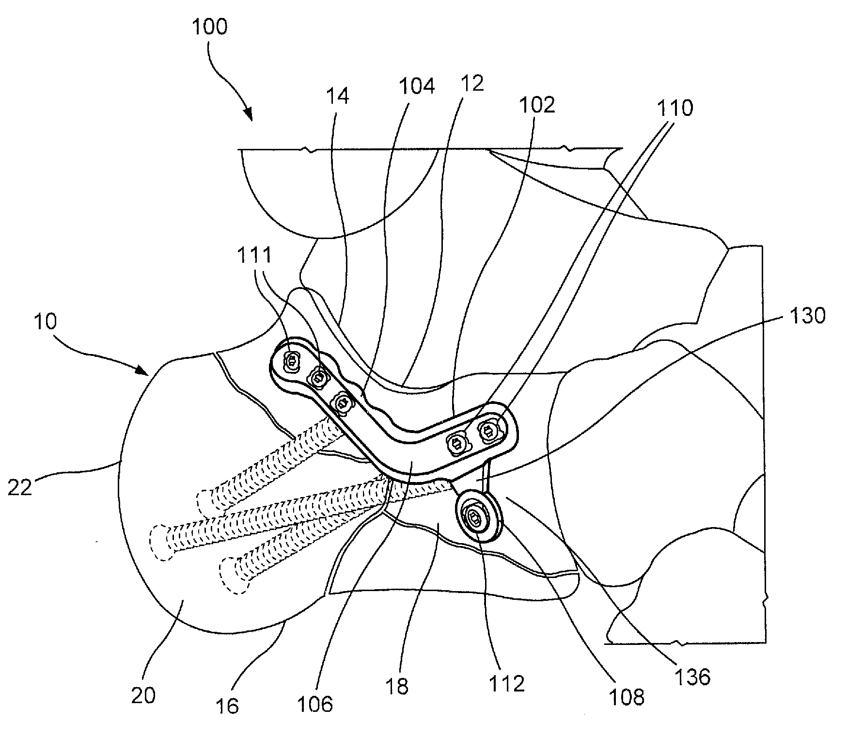 Anterolateral calcaneal plate