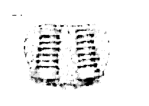 Use of adipose tissue-derived stromal cells in spinal fusion