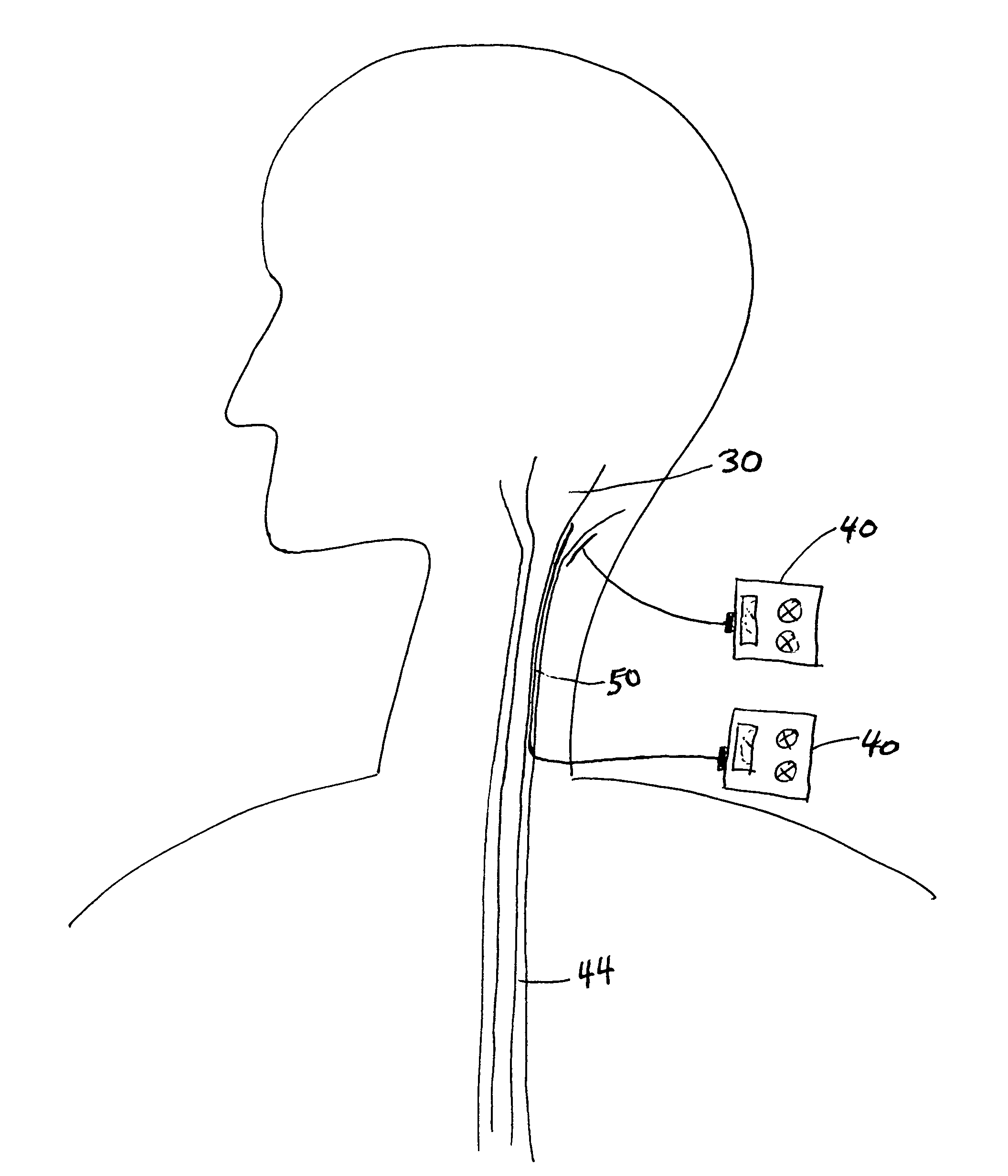 Enhancement of cerebral blood flow by electrical nerve stimulation