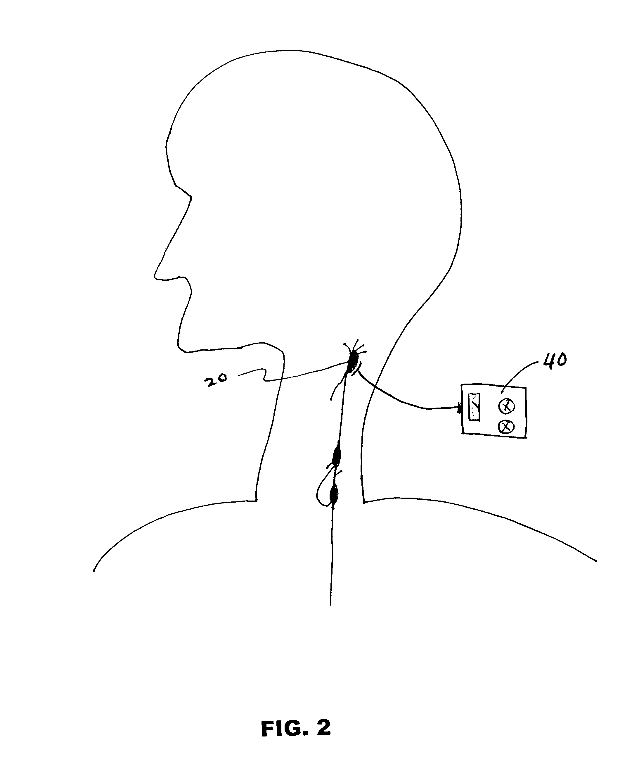 Enhancement of cerebral blood flow by electrical nerve stimulation