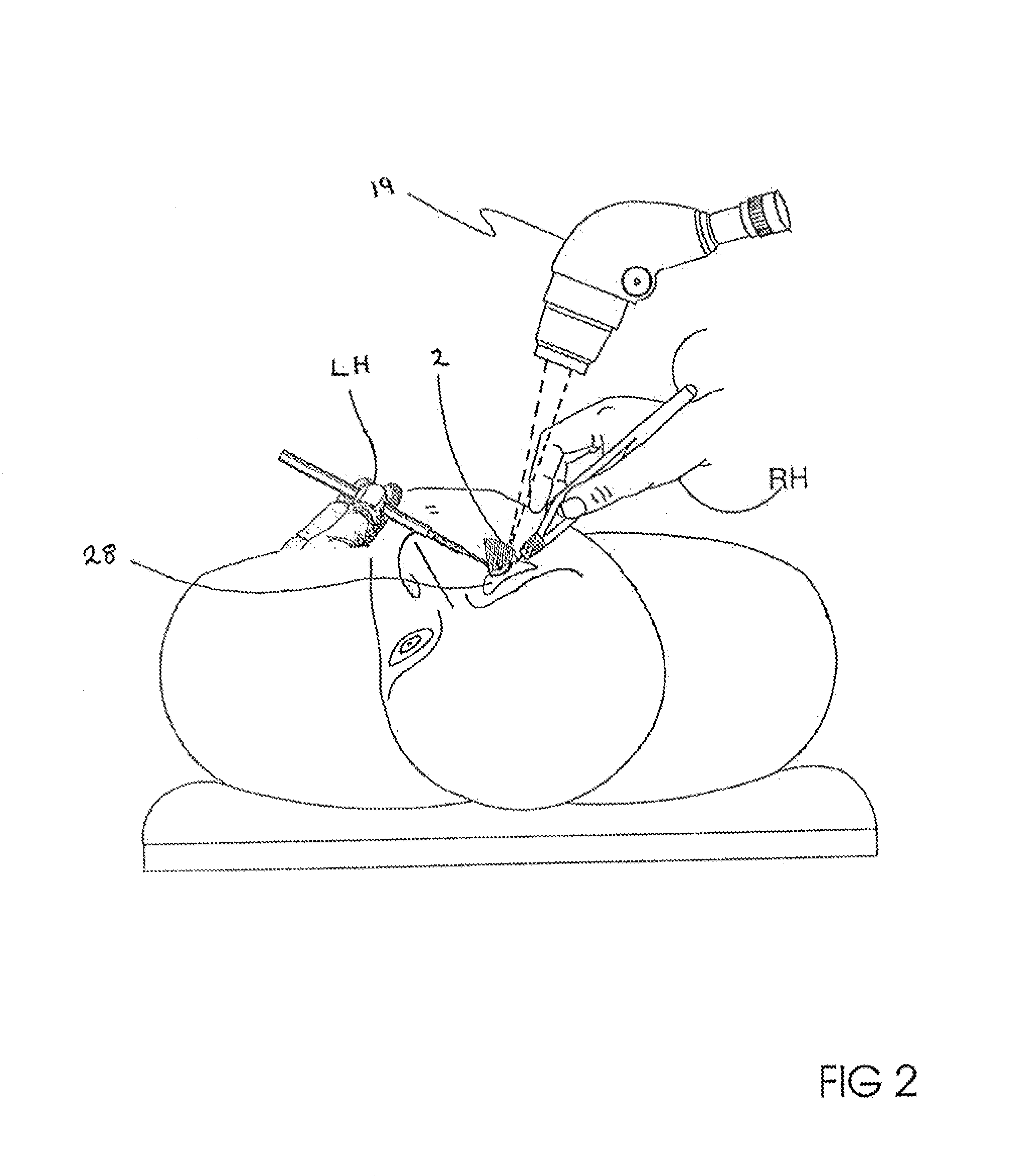 Suspended goniolens system