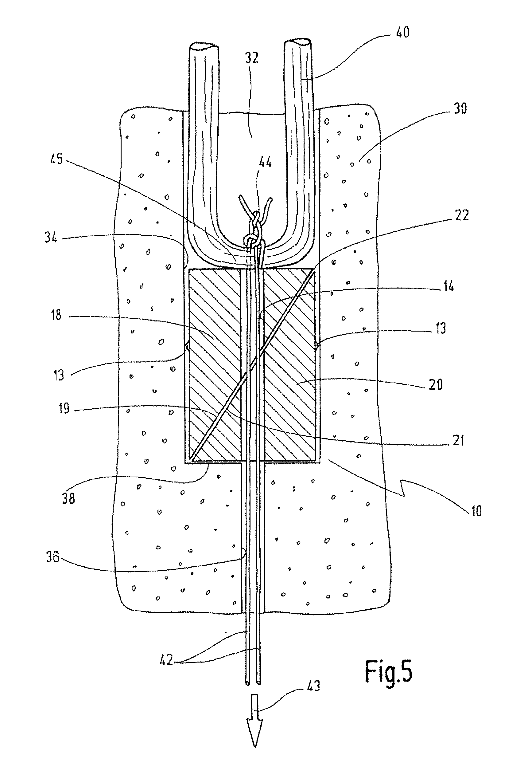 Device For Blocking A Tendon Graft