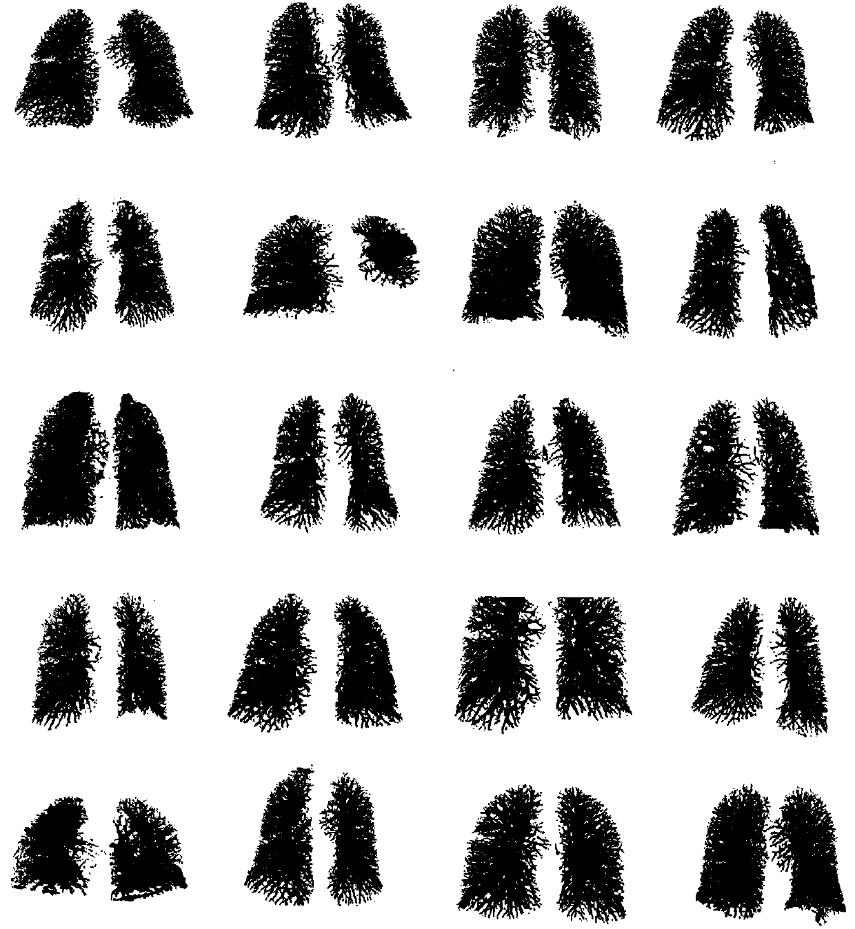 Pulmonary vascular tree segmentation method with tubular structure enhancement and energy function combined