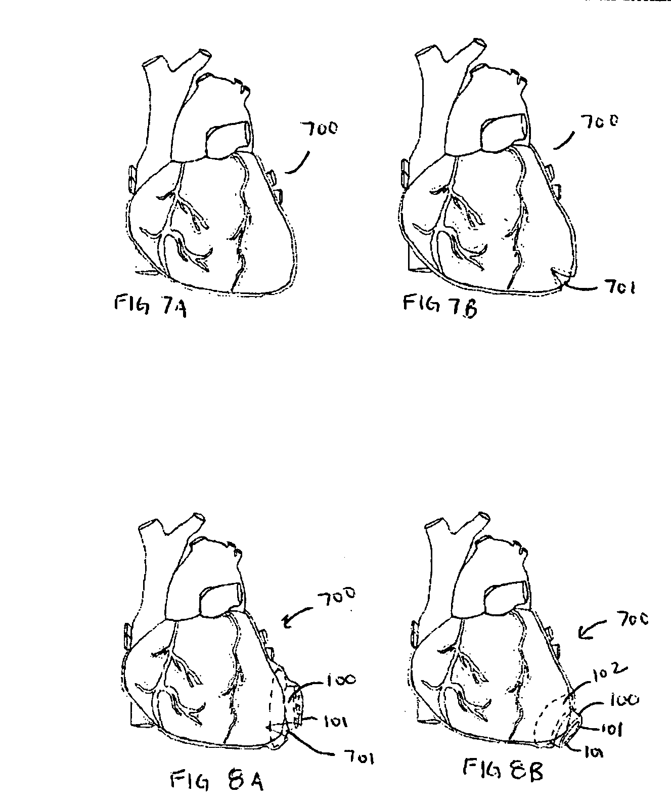 Apparatus and method for minimally invasive implantation of heart assist device