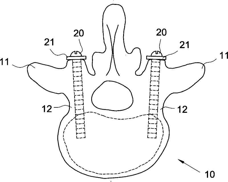 Fixing device for neutralizing actions between two vertebral bodies