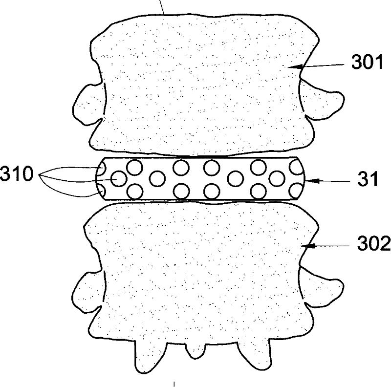 Fixing device for neutralizing actions between two vertebral bodies