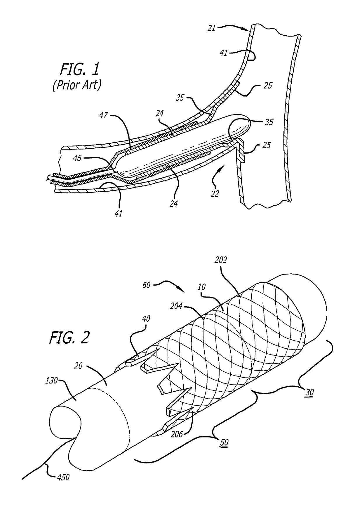 System and method for deploying a proximally-flaring stent