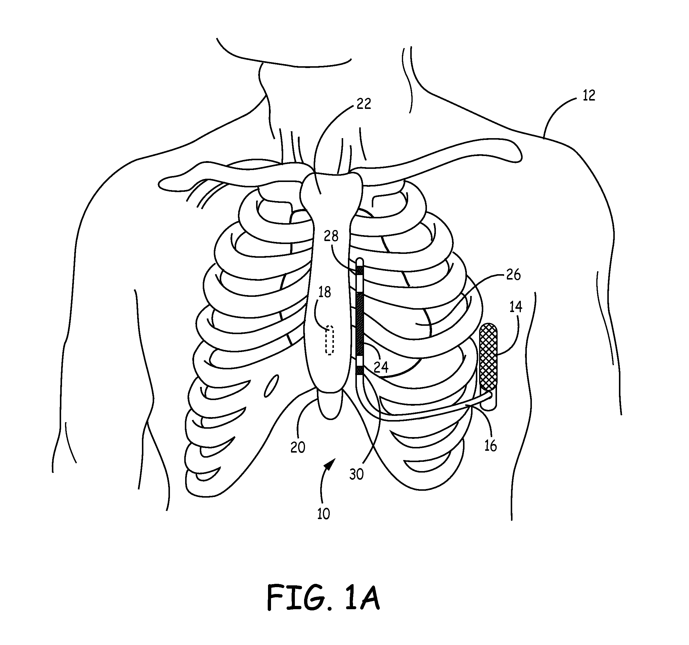 Implantable medical device system having implantable cardioverter-defibrillator (ICD) system and substernal leadless pacing device