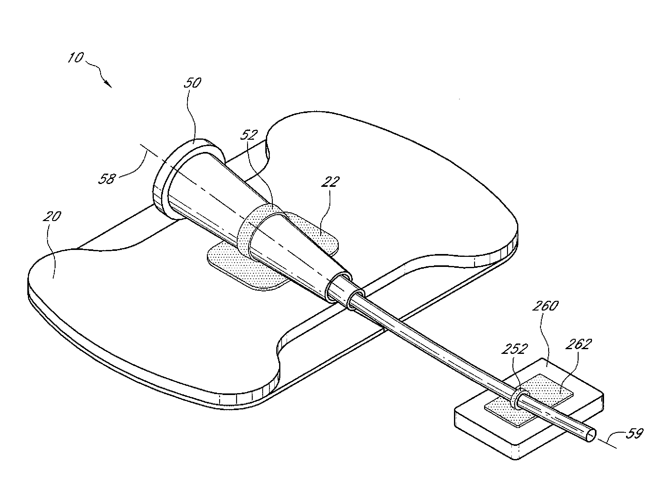 Securement system for a medical article