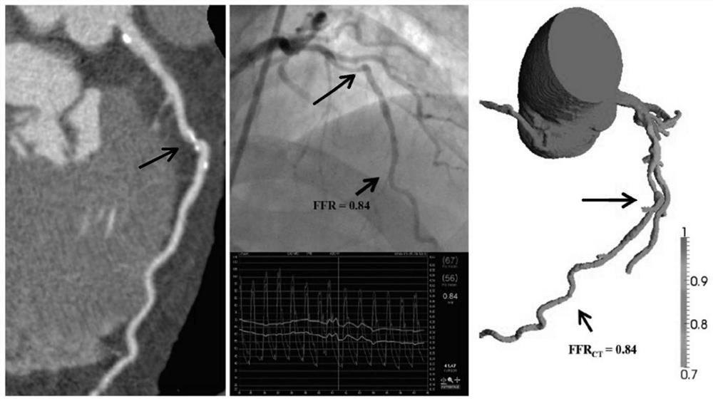 Coronary artery microcirculation detection and coronary artery analysis system