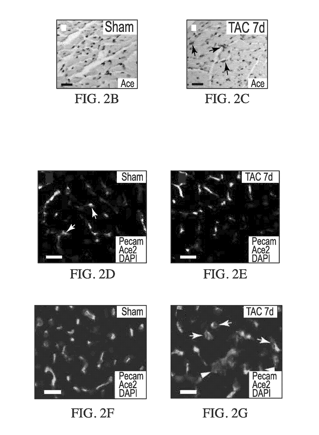 Antithetical regulation of endothelial ace and ace2 by brg1-foxm1 complex underlies pathological cardiac hypertrophy