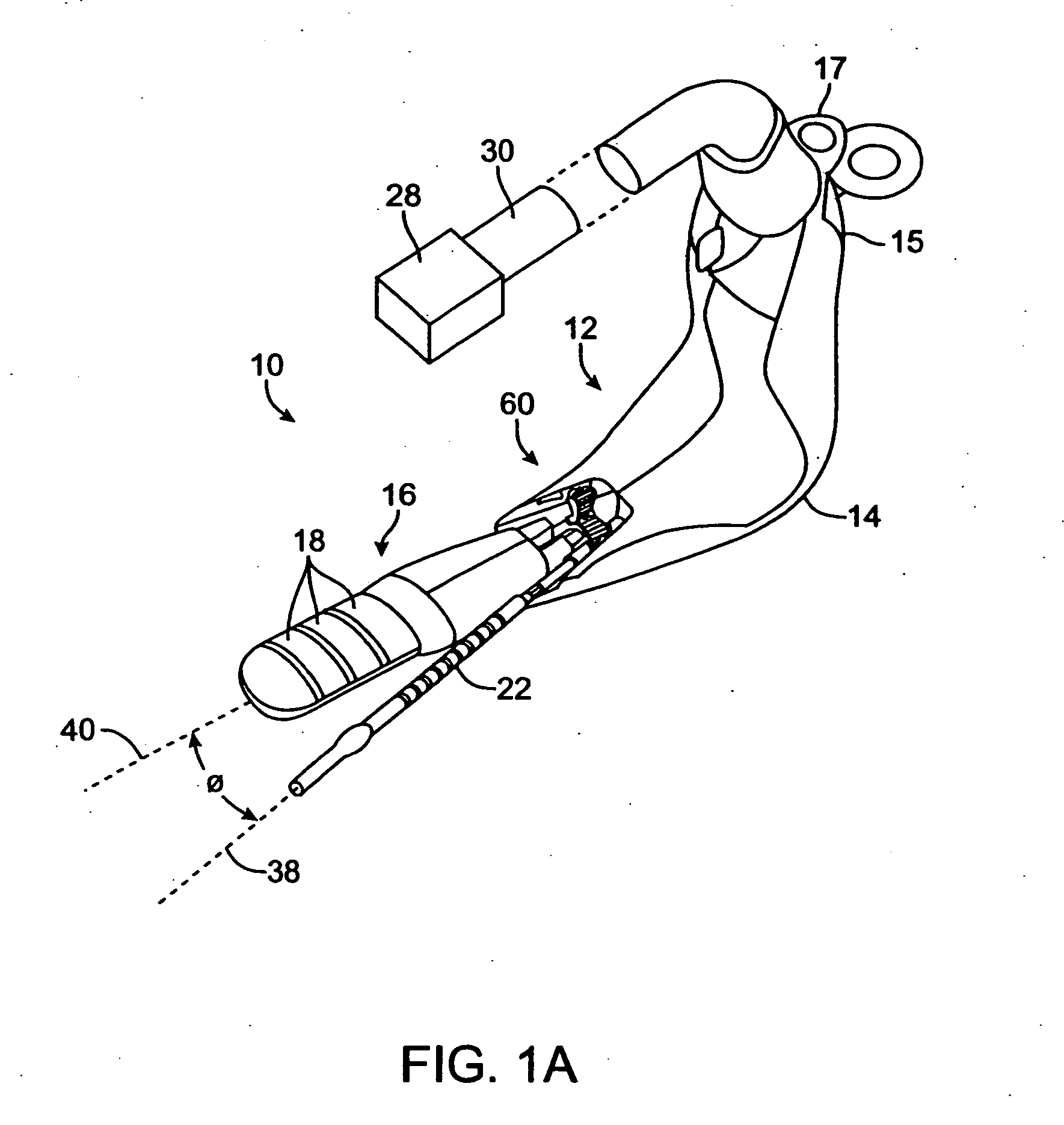 Incontinence treatment with urethral guide